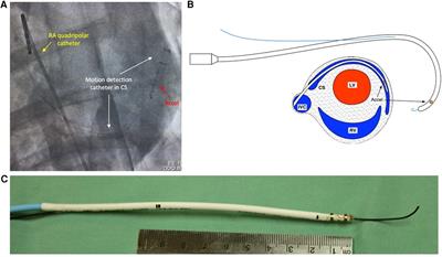 Intra-cardiac motion detection catheter for the early identification of acute pericardial tamponade during invasive cardiac procedures